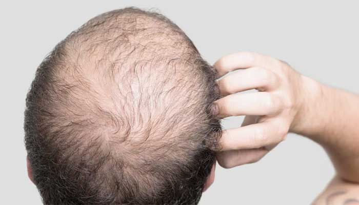 bald